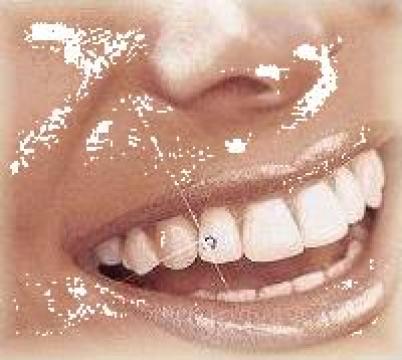 Bijuterii dentare