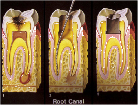 Endodontie tratament la radacina dentara