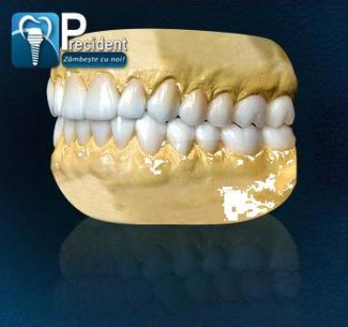 Simulare in ceara 3D - Wax Up dentar