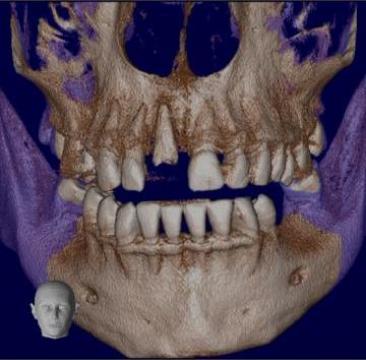 Tomografie 3D (cbct) sinusuri maxilare