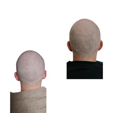 Micropigmentare scalp - cicatrici
