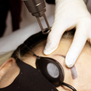 Curs acreditat indepartare tatuaje de la L'Ortec Medical
